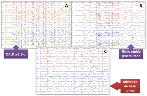 Neurovirtual / Sleepvirtual Armadilha na interpretação do EEG
