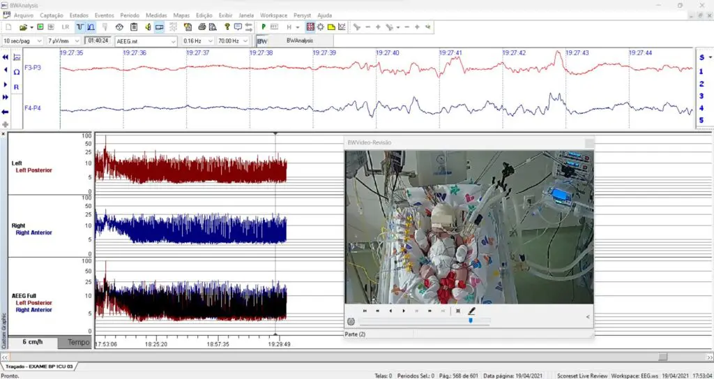 eeg 2008年 Neurovirtual / Sleepvirtual O Eletroencefalograma em Neonatos