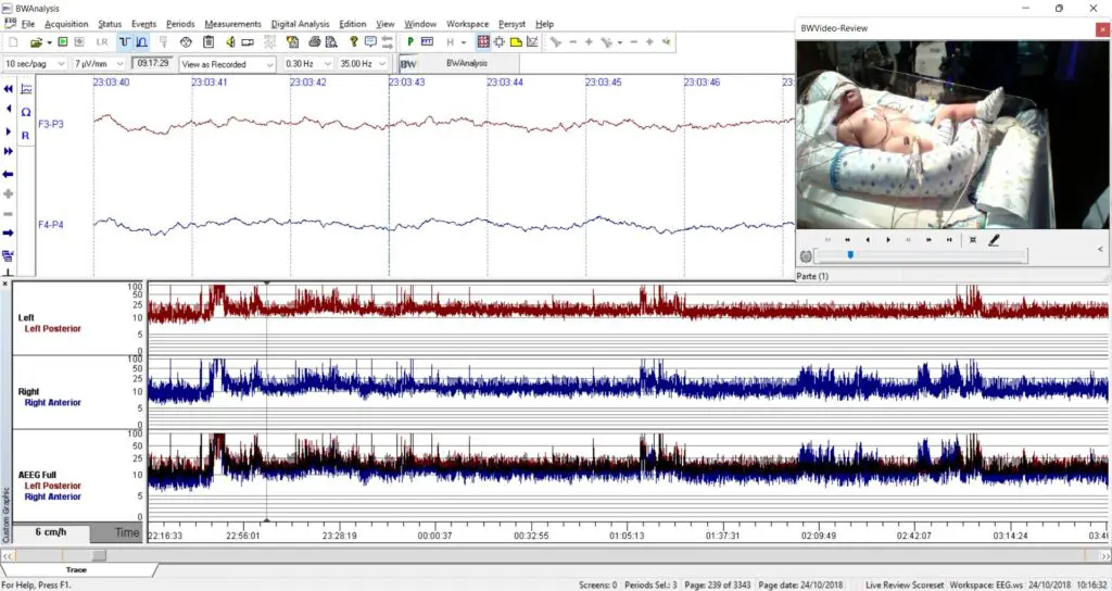 Neurovirtual / Sleepvirtual O Eletroencefalograma em Neonatos