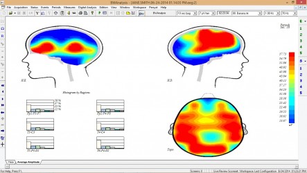 Electroencefalograma Digital Con Mapeo Cerebral - Neurovirtual ...